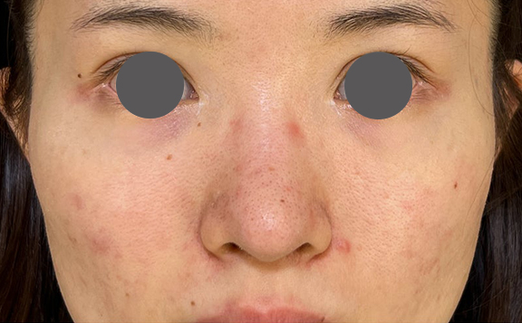 隆鼻術（シリコンプロテーゼ）,鼻を小さく細く見せるために隆鼻術（シリコンプロテーゼ）を行った症例写真,Before,ba_ryubi1064_b01.jpg