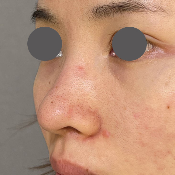 隆鼻術（シリコンプロテーゼ）,鼻を小さく細く見せるために隆鼻術（シリコンプロテーゼ）を行った症例写真,Before,ba_ryubi1064_b02.jpg