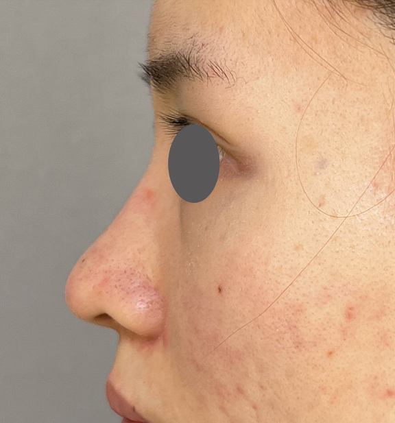 隆鼻術（シリコンプロテーゼ）,鼻を小さく細く見せるために隆鼻術（シリコンプロテーゼ）を行った症例写真,Before,ba_ryubi1064_b03.jpg