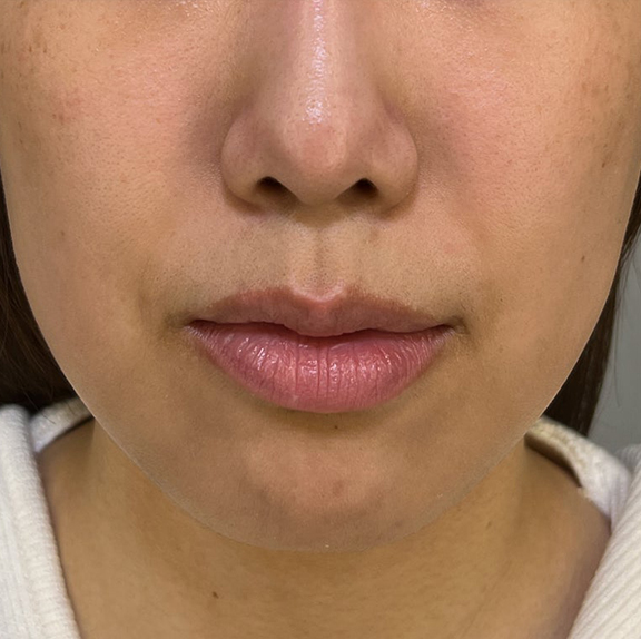 唇を薄く（口唇縮小術）,上下の唇を薄くした症例写真,Before,ba_usuku021_b01.jpg