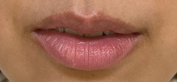 唇を薄く（口唇縮小術）,上下の唇を薄くした症例写真,Before,ba_usuku021_b02.jpg