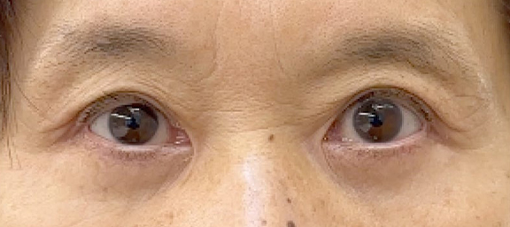 眼瞼下垂（がんけんかすい）,強い窪み目と目の開けづらさを改善した眼瞼下垂の症例写真,After（3ヶ月後）,ba_ganken046_a01.jpg