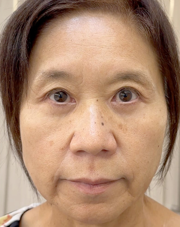 眼瞼下垂（がんけんかすい）,強い窪み目と目の開けづらさを改善した眼瞼下垂の症例写真,After（3ヶ月後）,ba_ganken046_b02.jpg