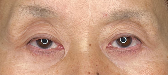 強い窪み目と目の開けづらさを改善した眼瞼下垂の症例写真,Before,ba_ganken046_b01.jpg