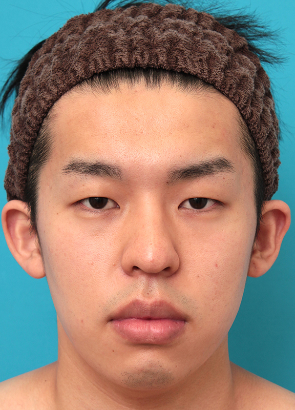 眼瞼下垂（がんけんかすい）,眼瞼下垂手術で目を大きくして二重を作った20代男性の症例写真,Before,ba_ganken047_b01.jpg