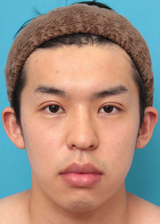 眼瞼下垂（がんけんかすい）,眼瞼下垂手術で目を大きくして二重を作った20代男性の症例写真,6日後,mainpic_ganken047c.jpg