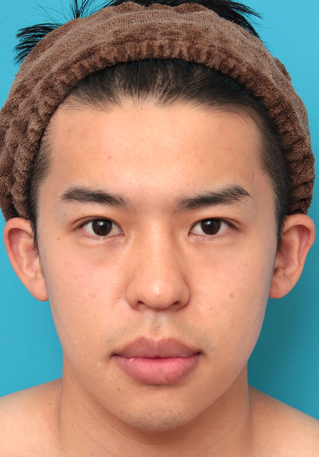 眼瞼下垂（がんけんかすい）,眼瞼下垂手術で目を大きくして二重を作った20代男性の症例写真,3週間後,mainpic_ganken047d.jpg