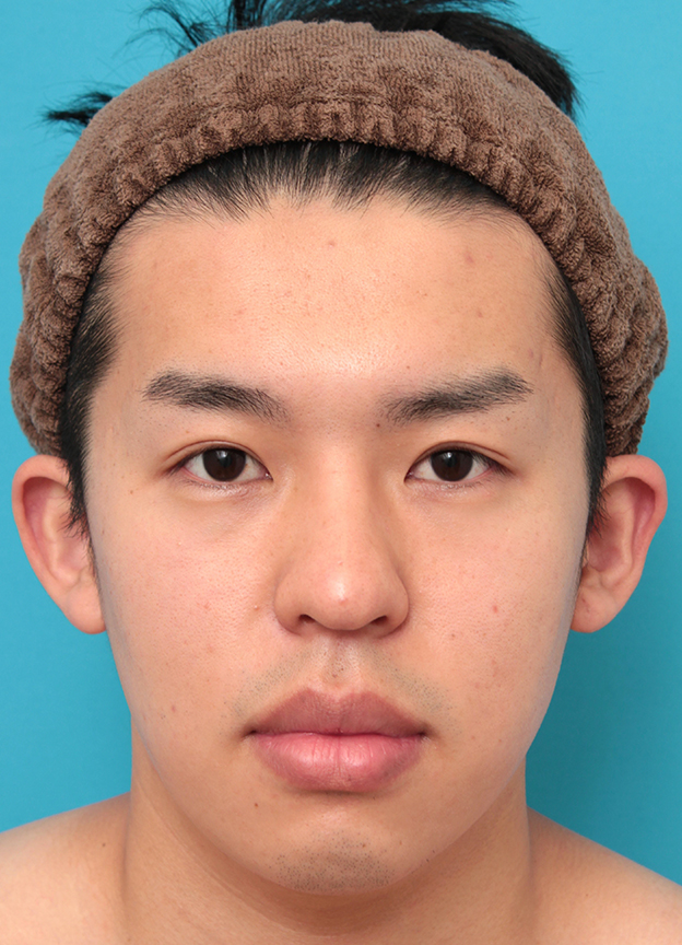 眼瞼下垂（がんけんかすい）,眼瞼下垂手術で目を大きくして二重を作った20代男性の症例写真,6ヶ月後,mainpic_ganken047e.jpg