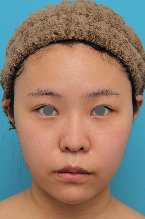 唇を薄く（口唇縮小術）,顎シリコンプロテーゼ+下唇薄くする手術を行った20代女性の症例写真,After（2ヶ月後）,ba_ago025_b01.jpg