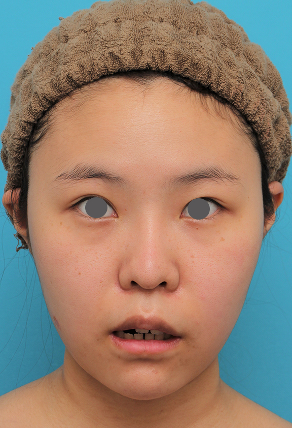 あご形成（シリコンプロテーゼ）,顎シリコンプロテーゼ+下唇薄くする手術を行った20代女性の症例写真,After（2ヶ月後）,ba_ago025_b02.jpg