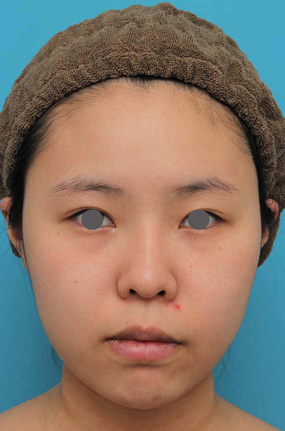 唇を薄く（口唇縮小術）,顎シリコンプロテーゼ+下唇薄くする手術を行った20代女性の症例写真,Before,ba_ago025_b01.jpg