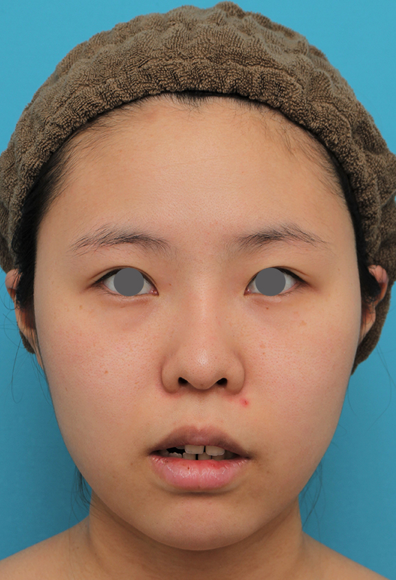 唇を薄く（口唇縮小術）,顎シリコンプロテーゼ+下唇薄くする手術を行った20代女性の症例写真,Before,ba_ago025_b02.jpg