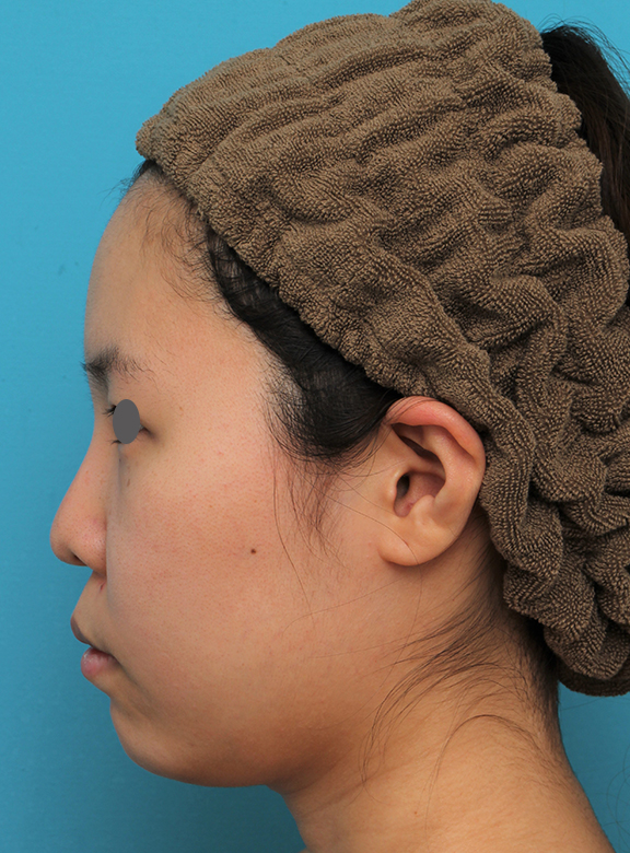 あご形成（シリコンプロテーゼ）,顎シリコンプロテーゼ+下唇薄くする手術を行った20代女性の症例写真,Before,ba_ago025_b03.jpg