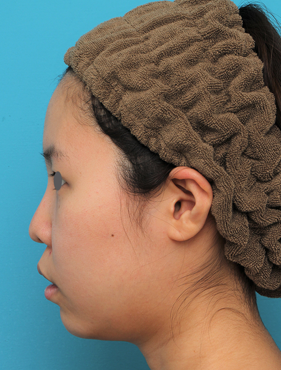 あご形成（シリコンプロテーゼ）,顎シリコンプロテーゼ+下唇薄くする手術を行った20代女性の症例写真,Before,ba_ago025_b04.jpg