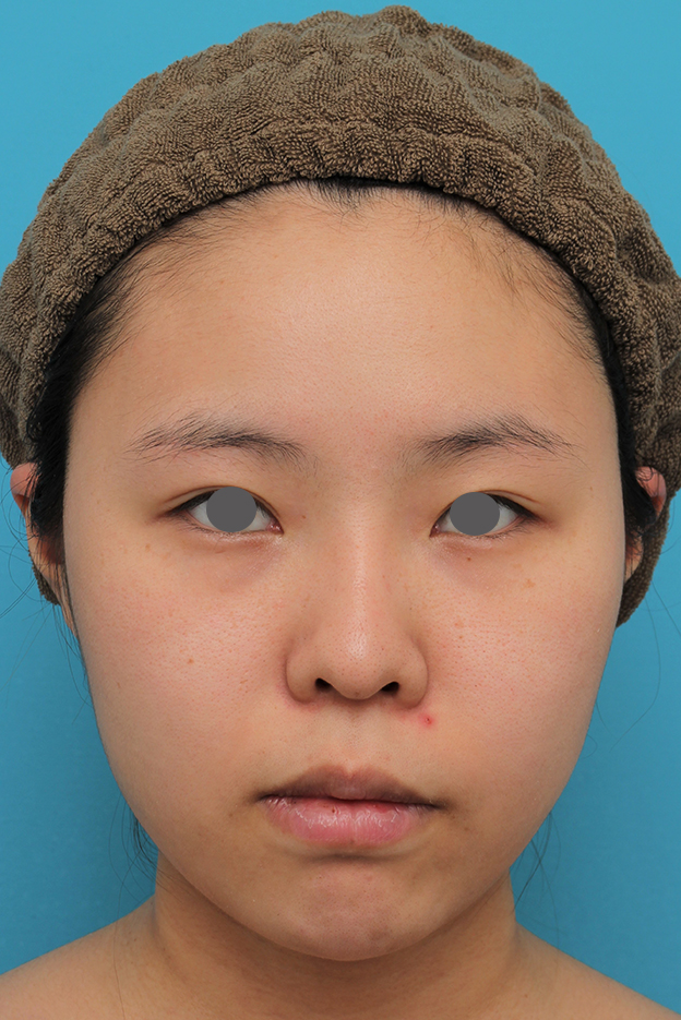 あご形成（シリコンプロテーゼ）,顎シリコンプロテーゼ+下唇薄くする手術を行った20代女性の症例写真,手術前,mainpic_ago025a.jpg
