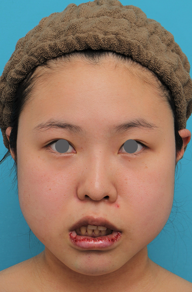 あご形成（シリコンプロテーゼ）,顎シリコンプロテーゼ+下唇薄くする手術を行った20代女性の症例写真,手術直後,mainpic_ago025c.jpg
