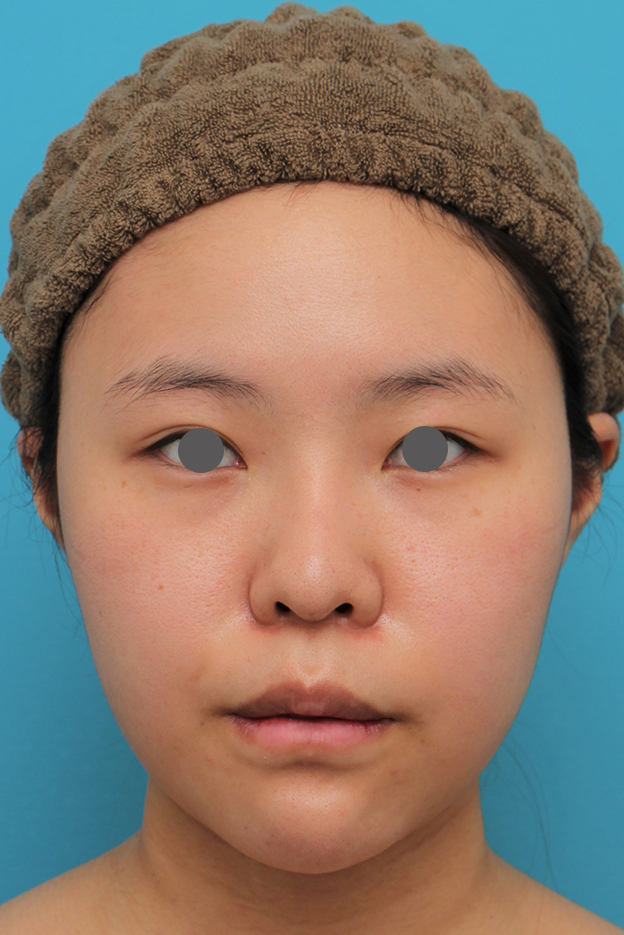 唇を薄く（口唇縮小術）,顎シリコンプロテーゼ+下唇薄くする手術を行った20代女性の症例写真,10日後,mainpic_ago025d.jpg