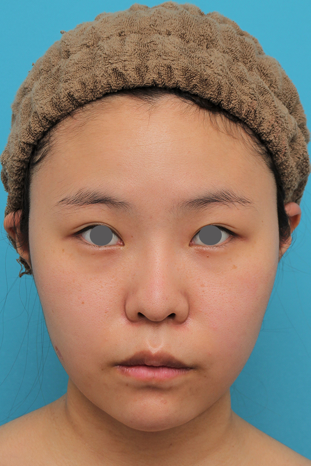 唇を薄く（口唇縮小術）,顎シリコンプロテーゼ+下唇薄くする手術を行った20代女性の症例写真,2ヶ月後,mainpic_ago025f.jpg