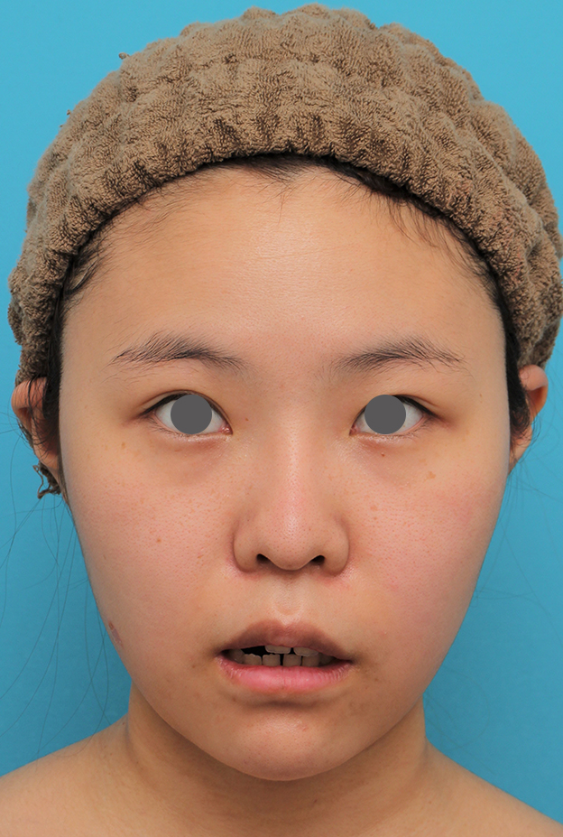 唇を薄く（口唇縮小術）,顎シリコンプロテーゼ+下唇薄くする手術を行った20代女性の症例写真,2ヶ月後,mainpic_ago025g.jpg