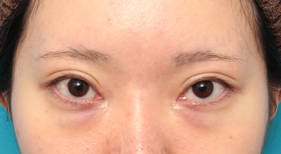 目の下の脂肪取り,タレ目形成手術（グラマラスライン）と目の下脂肪取り（脱脂）を同時に行った20代女性の症例写真,Before,ba_panda024_b01.jpg