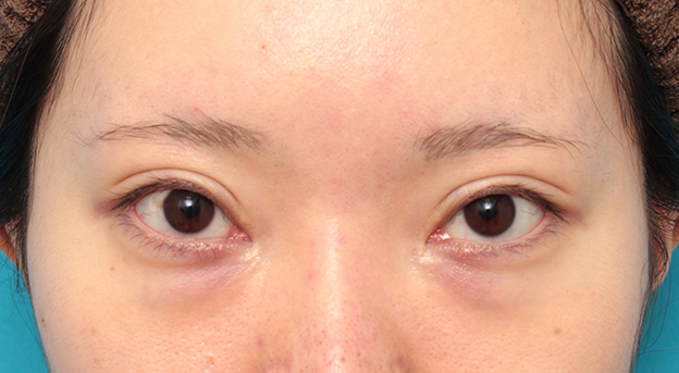 目の下の脂肪取り,タレ目形成手術（グラマラスライン）と目の下脂肪取り（脱脂）を同時に行った20代女性の症例写真,手術前,mainpic_panda024a.jpg