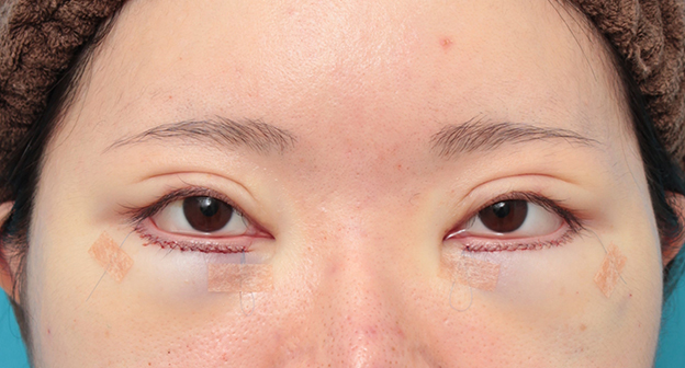 目の下の脂肪取り,タレ目形成手術（グラマラスライン）と目の下脂肪取り（脱脂）を同時に行った20代女性の症例写真,手術直後,mainpic_panda024b.jpg