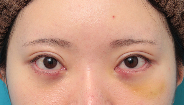 垂れ目（パンダ目）形成（グラマラスライン／下眼瞼下制術）,タレ目形成手術（グラマラスライン）と目の下脂肪取り（脱脂）を同時に行った20代女性の症例写真,6日後,mainpic_panda024c.jpg