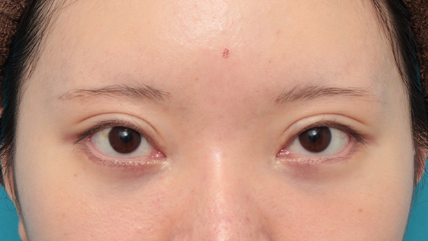 垂れ目（パンダ目）形成（グラマラスライン／下眼瞼下制術）,タレ目形成手術（グラマラスライン）と目の下脂肪取り（脱脂）を同時に行った20代女性の症例写真,3週間後,mainpic_panda024d.jpg