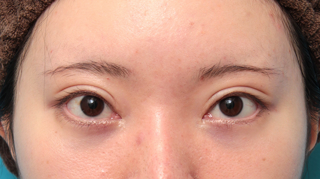 垂れ目（パンダ目）形成（グラマラスライン／下眼瞼下制術）,タレ目形成手術（グラマラスライン）と目の下脂肪取り（脱脂）を同時に行った20代女性の症例写真,4ヶ月後,mainpic_panda024e.jpg