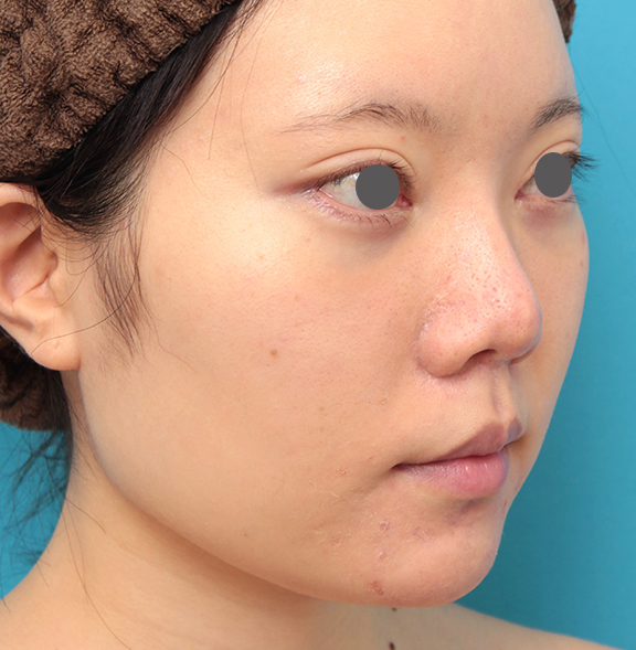 鼻の下を短く（上口唇短縮手術、上口唇リフト、リップリフト、人中短縮術）,人中短縮手術を行った20代女性の症例写真,After（9ヶ月後）,ba_hanashita013_b02.jpg
