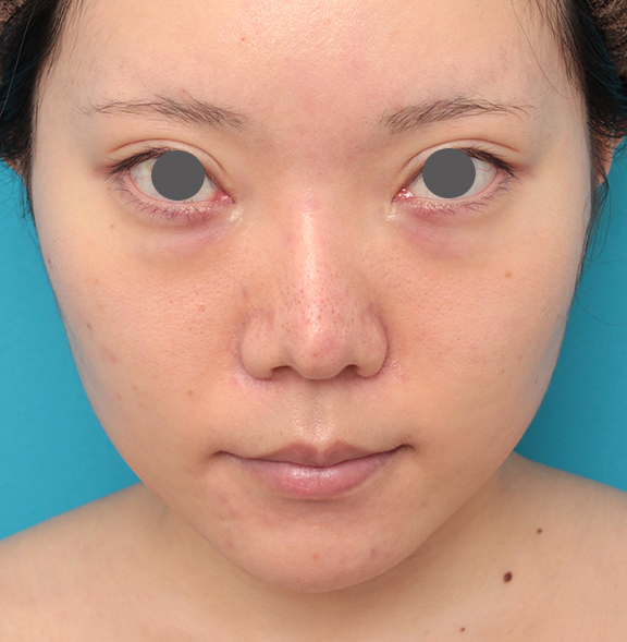 鼻の下を短く（上口唇短縮手術、上口唇リフト、リップリフト、人中短縮術）,人中短縮手術を行った20代女性の症例写真,Before,ba_hanashita013_b01.jpg