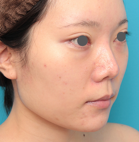 鼻の下を短く（上口唇短縮手術、上口唇リフト、リップリフト、人中短縮術）,人中短縮手術を行った20代女性の症例写真,Before,ba_hanashita013_b02.jpg