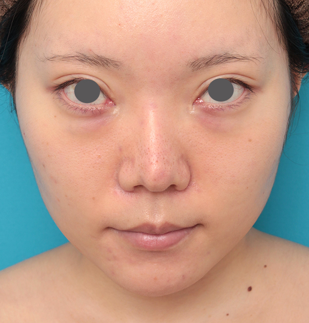 鼻の下を短く（上口唇短縮手術、上口唇リフト、リップリフト、人中短縮術）,人中短縮手術を行った20代女性の症例写真,手術前,mainpic_hanashita013a.jpg