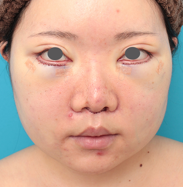 鼻の下を短く（上口唇短縮手術、上口唇リフト、リップリフト、人中短縮術）,人中短縮手術を行った20代女性の症例写真,手術直後,mainpic_hanashita013b.jpg