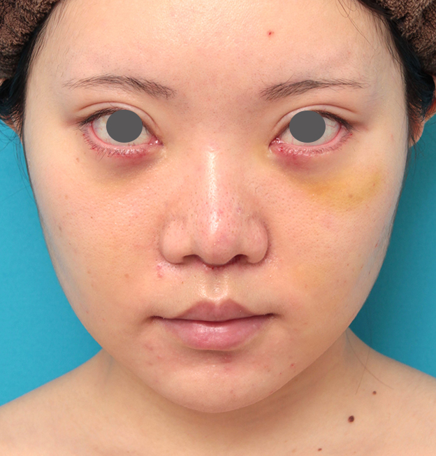 鼻の下を短く（上口唇短縮手術、上口唇リフト、リップリフト、人中短縮術）,人中短縮手術を行った20代女性の症例写真,6日後,mainpic_hanashita013c.jpg