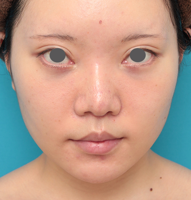 鼻の下を短く（上口唇短縮手術、上口唇リフト、リップリフト、人中短縮術）,人中短縮手術を行った20代女性の症例写真,3週間後,mainpic_hanashita013d.jpg
