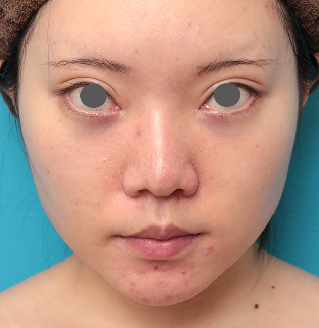 鼻の下を短く（上口唇短縮手術、上口唇リフト、リップリフト、人中短縮術）,人中短縮手術を行った20代女性の症例写真,4ヶ月後,mainpic_hanashita013e.jpg