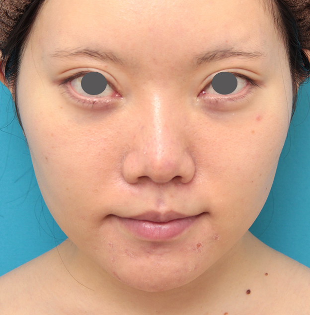 鼻の下を短く（上口唇短縮手術、上口唇リフト、リップリフト、人中短縮術）,人中短縮手術を行った20代女性の症例写真,9ヶ月後,mainpic_hanashita013f.jpg