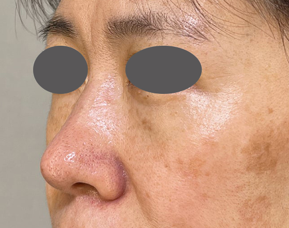 耳介軟骨移植（鼻先を出す）,耳介軟骨移植で鼻の丸みを修正した症例写真,After（3ヶ月後）,ba_jikai051_b01.jpg