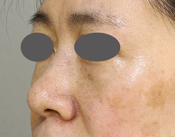耳介軟骨移植（鼻先を出す）,耳介軟骨移植で鼻の丸みを修正した症例写真,Before,ba_jikai051_b01.jpg
