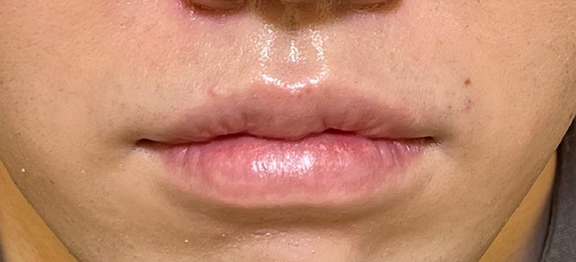 症例写真,唇の厚さが4:6になるように口唇縮小術を行った症例写真,After（1ヶ月後）,ba_usuku022_b01.jpg