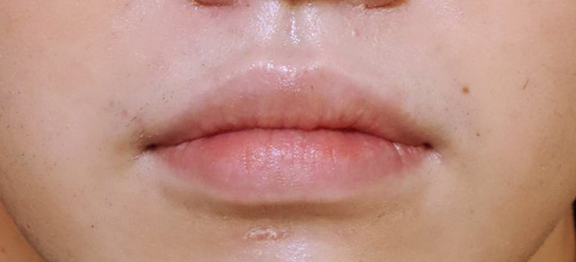 唇を薄く（口唇縮小術）,唇の厚さが4:6になるように口唇縮小術を行った症例写真,Before,ba_usuku022_b01.jpg