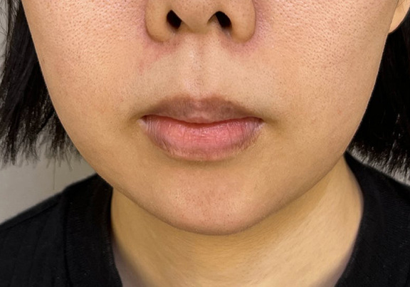 症例写真,顎プロテーゼであごをシャープにした症例写真,After（3ヶ月後）,ba_ago026_b01.jpg