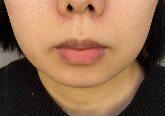 症例写真,顎プロテーゼであごをシャープにした症例写真,Before,ba_ago026_b01.jpg