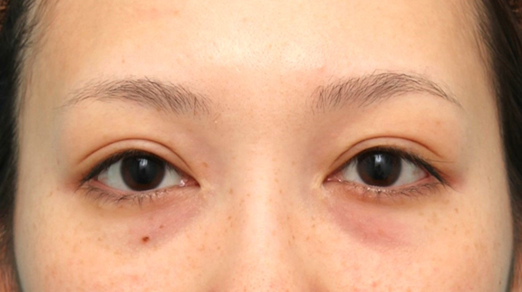 蒙古ひだ形成・目頭切開後の修正,他院で切られすぎた目頭切開を蒙古襞形成で戻した女性の症例写真,Before,ba_hida012_b01.jpg