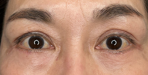 目の下のたるみ取り,切開で目の下のたるみ取りを行った症例写真,After（3ヶ月後）,ba_tarumi_under003_a01.jpg