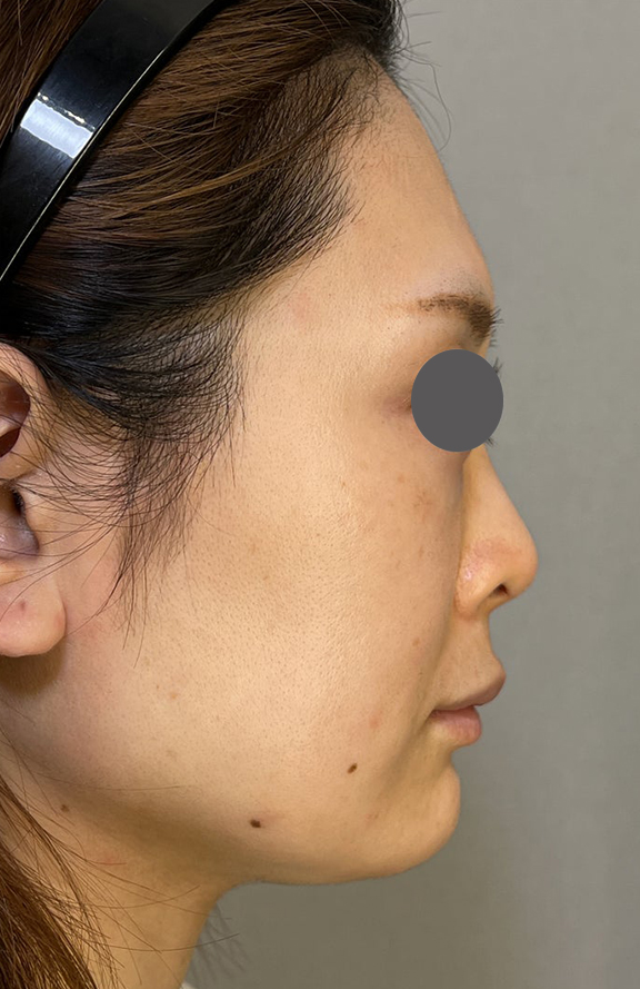 耳介軟骨移植（鼻先を出す）,耳介軟骨移植でスッキリとした鼻先になった症例写真,Before,ba_jikai052_b02.jpg
