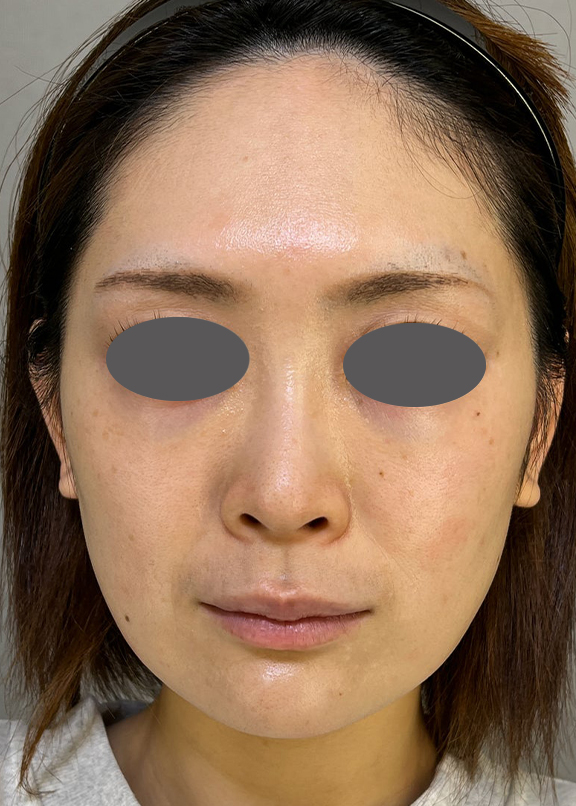 症例写真,耳介軟骨移植でスッキリとした鼻先になった症例写真,Before,ba_jikai052_b03.jpg