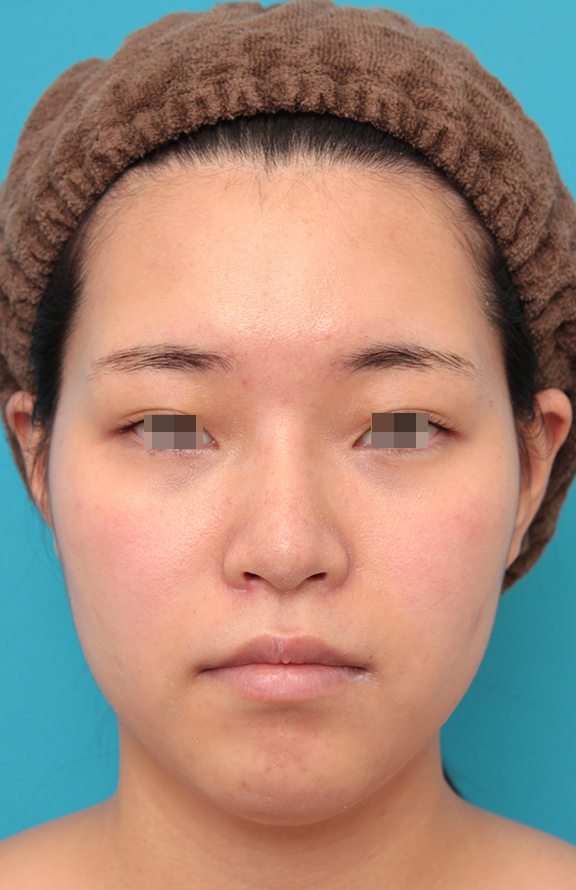 耳介軟骨移植（鼻先を出す）,鼻シリコンプロテーゼ＋鼻先耳介軟骨移植＋小鼻縮小を行った20代女性の症例写真,After（2ヶ月後）,ba_ryubi1065_b01.jpg