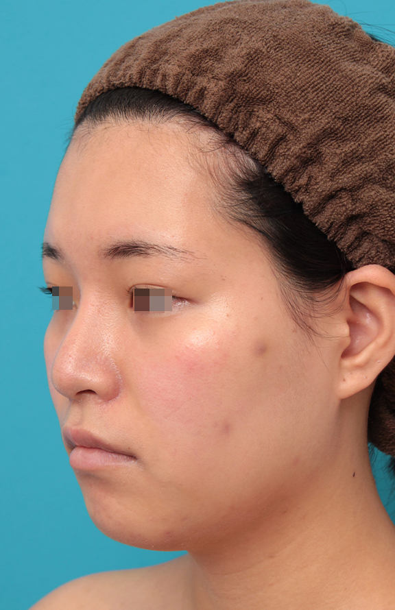 耳介軟骨移植（鼻先を出す）,鼻シリコンプロテーゼ＋鼻先耳介軟骨移植＋小鼻縮小を行った20代女性の症例写真,After（2ヶ月後）,ba_ryubi1065_b02.jpg